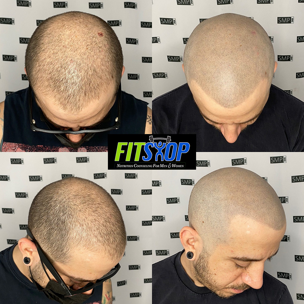 Before and after of an amazing procedure we did. We are the best in the art  of hair tattoo and scalp pigmentation. | Hair tattoos, Hairline tattoos, Scalp  tattoo