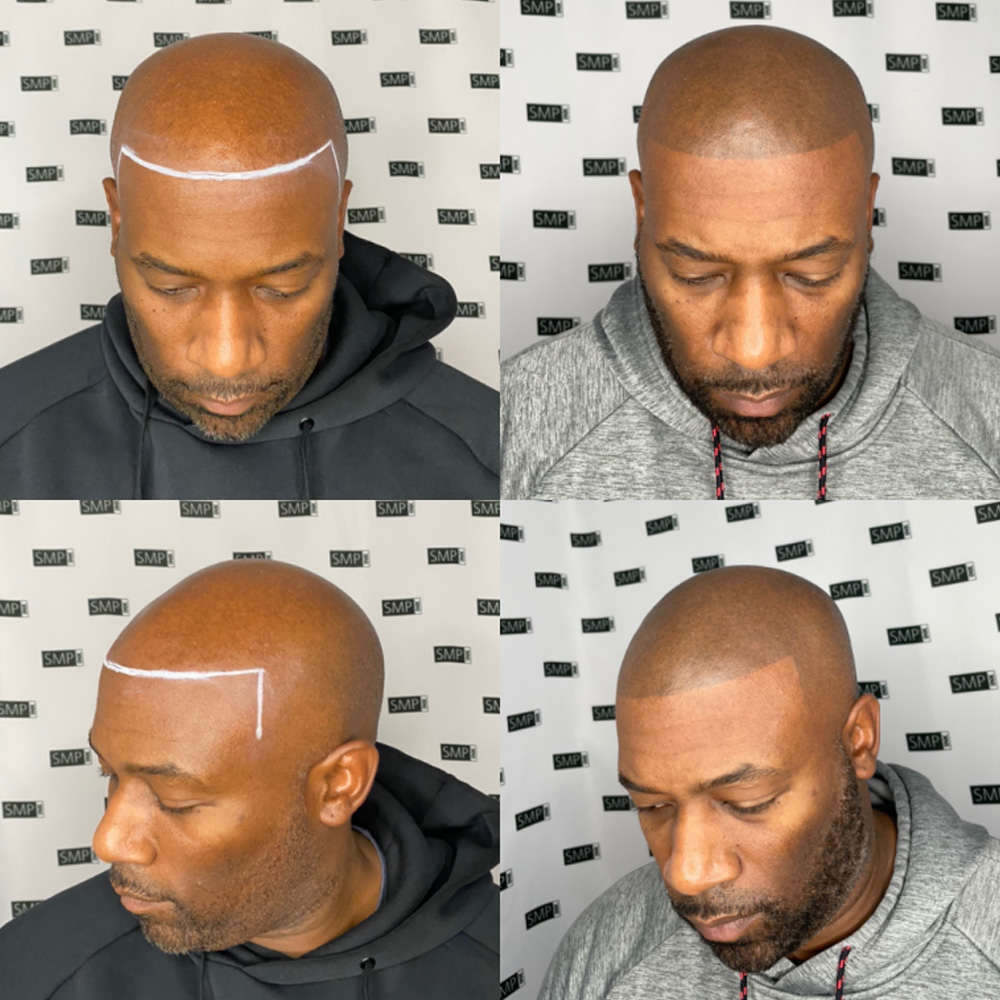 Scalp Aesthetics - Refine Clinic