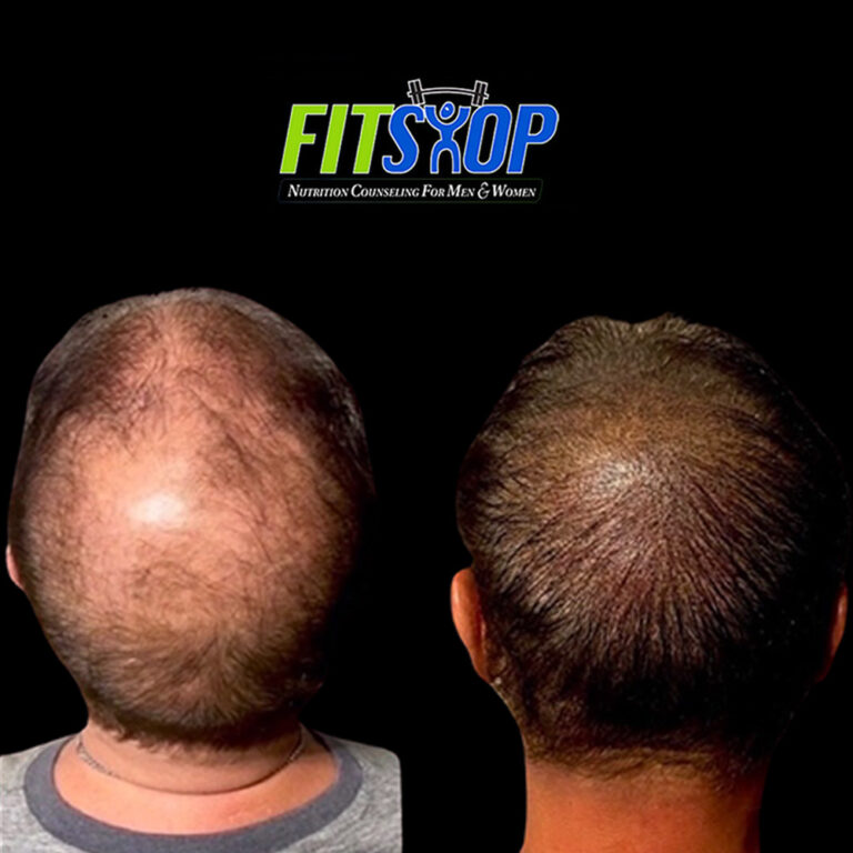 Scalp Micropigmentation Before and After - FitShop Weight Loss Clinic ...