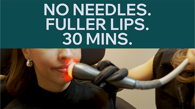 featured image No Needle Lip Plump That Actually Works – Non Surgical Fuller Lips in 30 Minutes