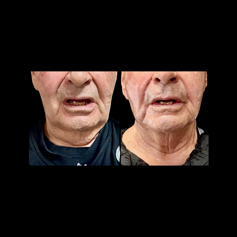 Face Sculpting Before and After 1