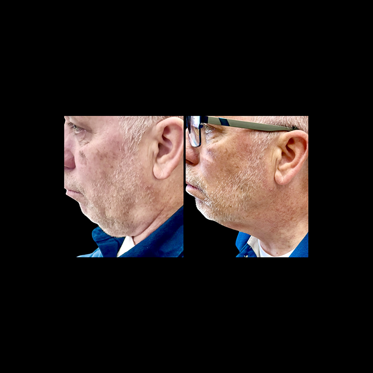 Face Sculpting Before and After 3