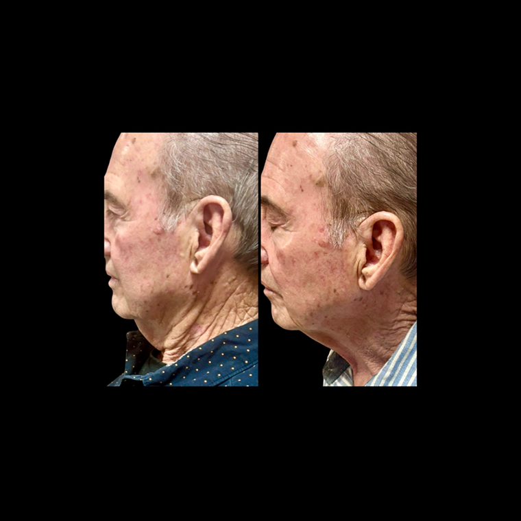 Face Sculpting Before and After 2